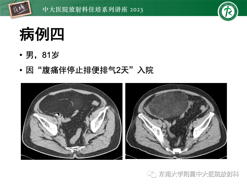 影像PPT - 【PPT】腹部脂肪坏死的影像诊断及主要鉴别-34