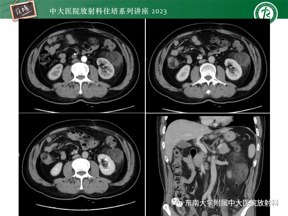 影像PPT - 【PPT】腹部脂肪坏死的影像诊断及主要鉴别-38