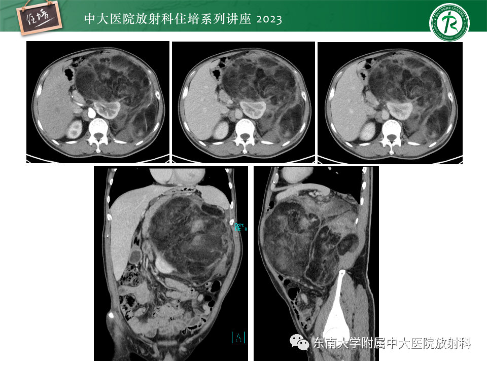 影像PPT - 【PPT】腹部脂肪坏死的影像诊断及主要鉴别-41