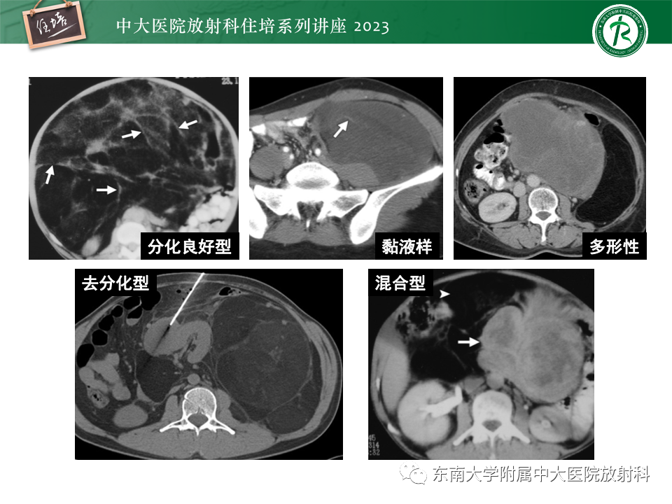 影像PPT - 【PPT】腹部脂肪坏死的影像诊断及主要鉴别-44