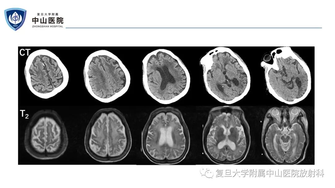 影像PPT - 【病例】神经元核内包涵体病1例CT及MR影像-3
