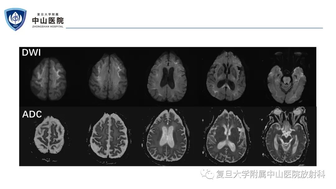 影像PPT - 【病例】神经元核内包涵体病1例CT及MR影像-4