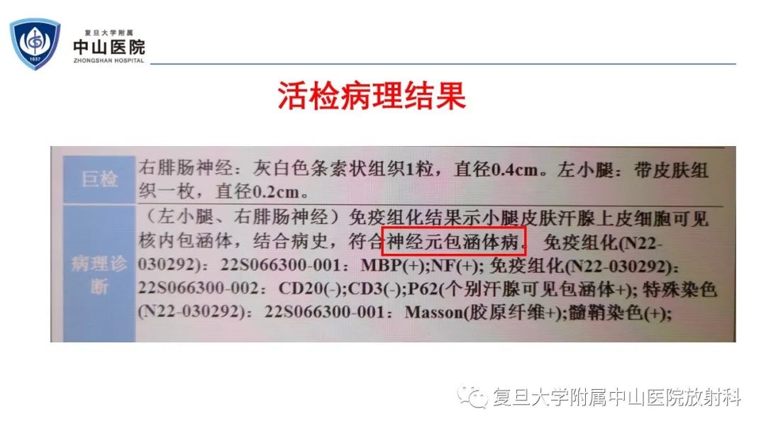 影像PPT - 【病例】神经元核内包涵体病1例CT及MR影像-6
