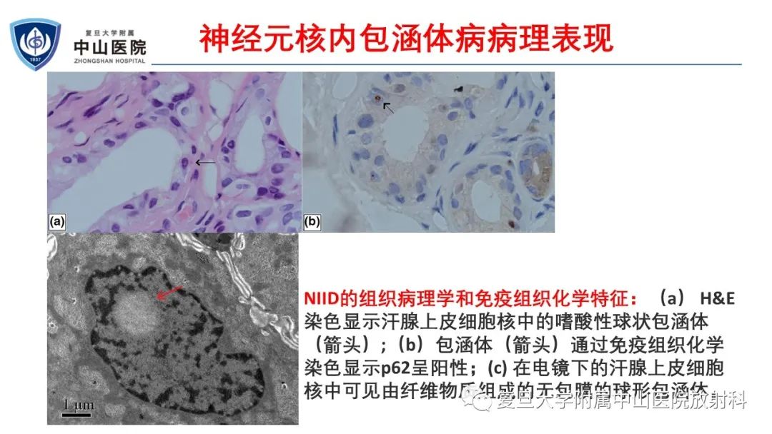 影像PPT - 【病例】神经元核内包涵体病1例CT及MR影像-10