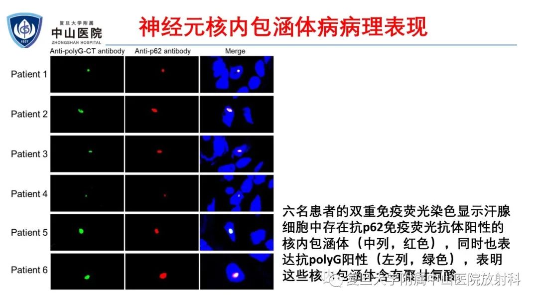 影像PPT - 【病例】神经元核内包涵体病1例CT及MR影像-11