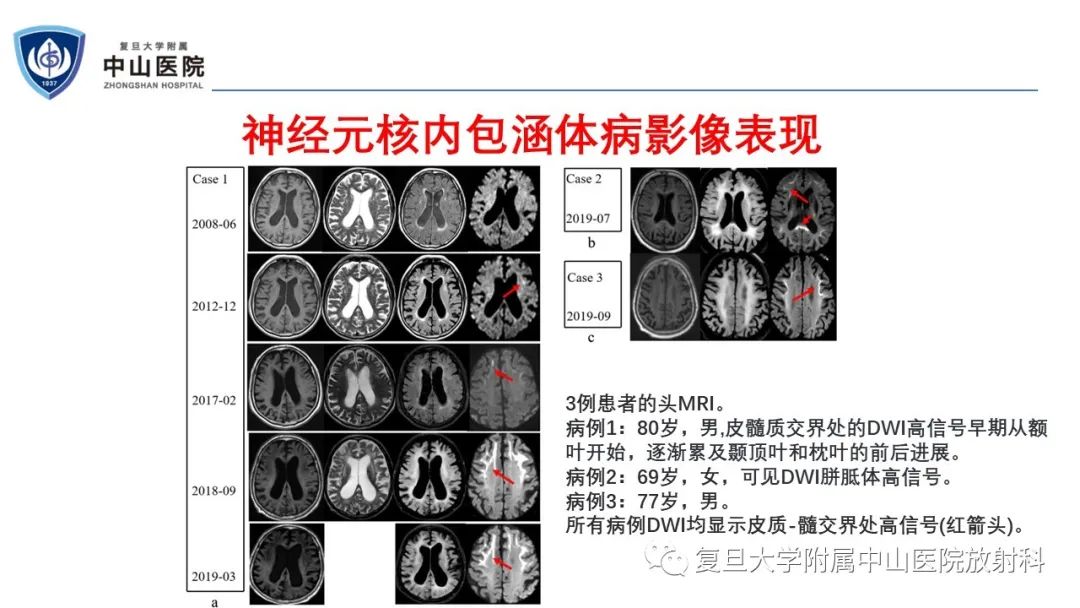 影像PPT - 【病例】神经元核内包涵体病1例CT及MR影像-15