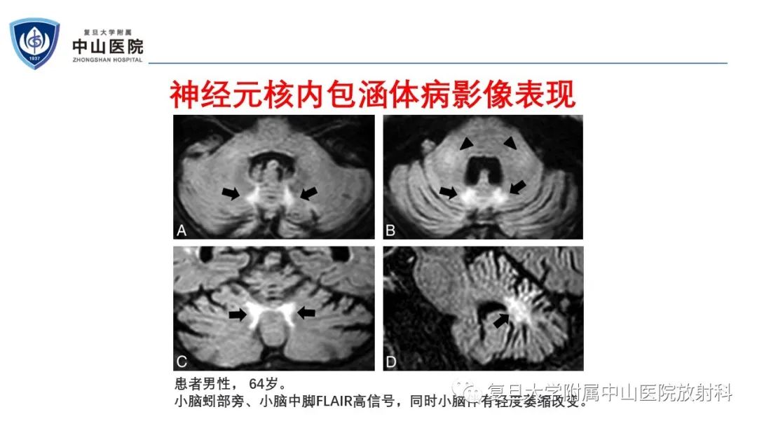 影像PPT - 【病例】神经元核内包涵体病1例CT及MR影像-16