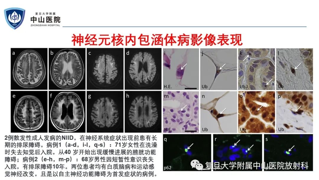 影像PPT - 【病例】神经元核内包涵体病1例CT及MR影像-17