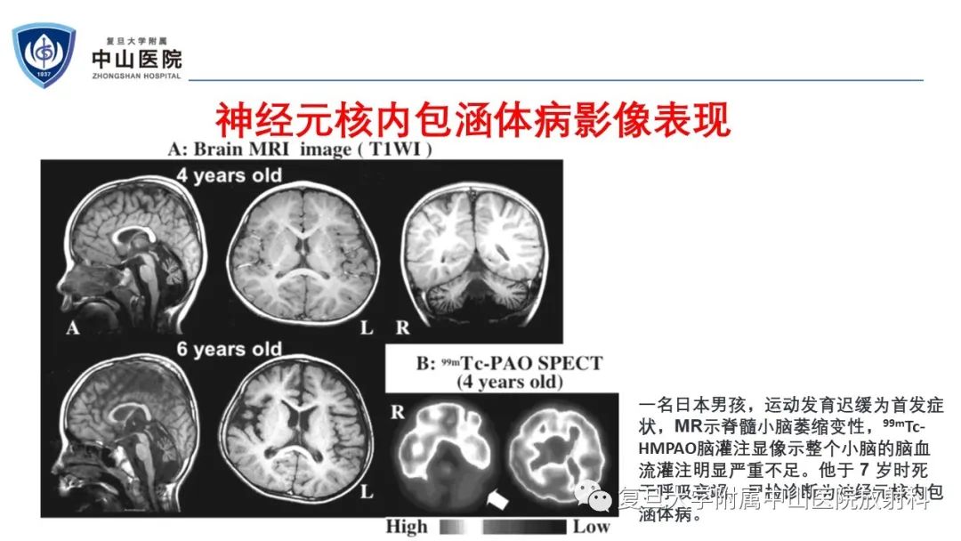 影像PPT - 【病例】神经元核内包涵体病1例CT及MR影像-18