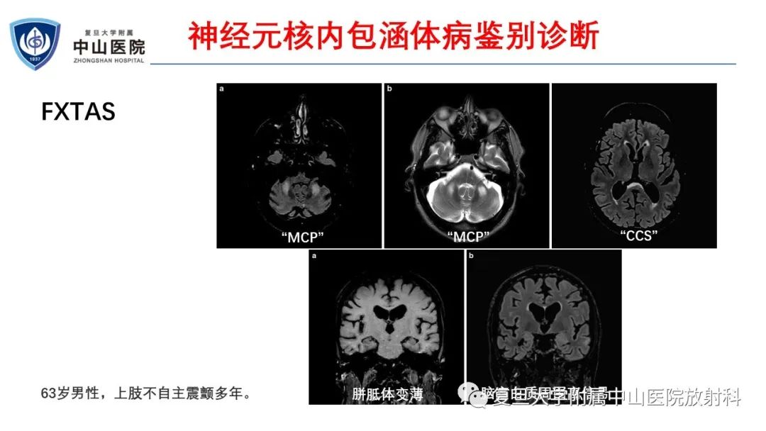 影像PPT - 【病例】神经元核内包涵体病1例CT及MR影像-20