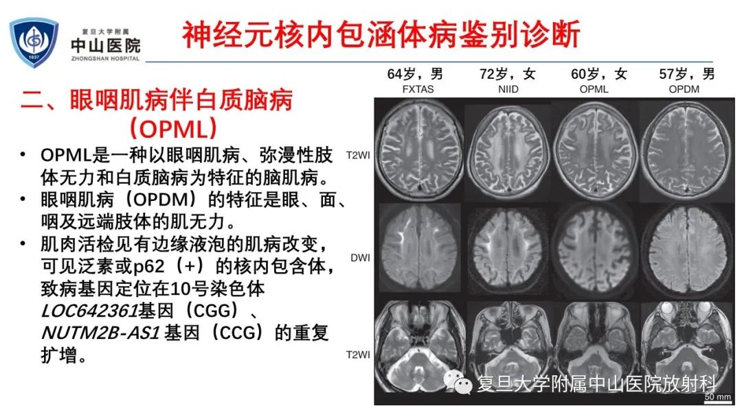 影像PPT - 【病例】神经元核内包涵体病1例CT及MR影像-21