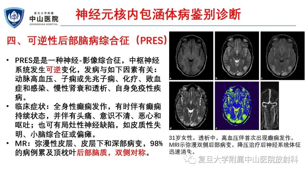 影像PPT - 【病例】神经元核内包涵体病1例CT及MR影像-24