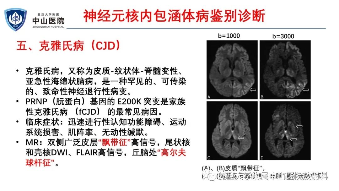 影像PPT - 【病例】神经元核内包涵体病1例CT及MR影像-25