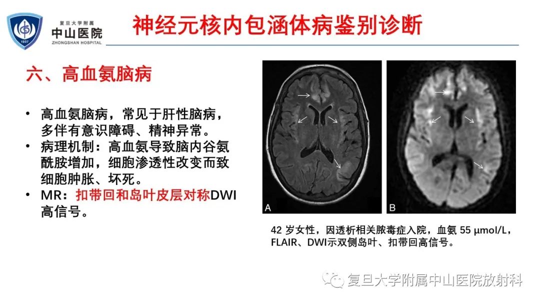 影像PPT - 【病例】神经元核内包涵体病1例CT及MR影像-26