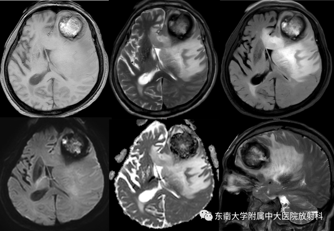 影像PPT - 【PPT】脑内血管肉瘤-1