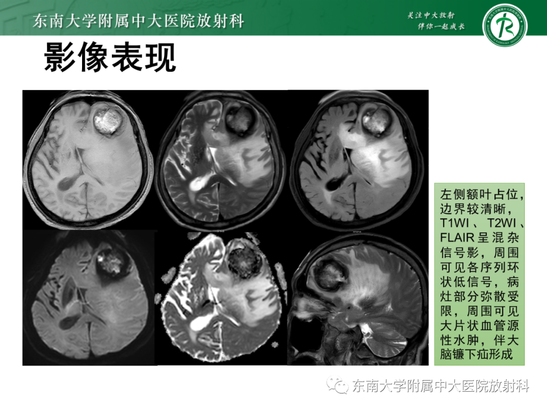 影像PPT - 【PPT】脑内血管肉瘤-3