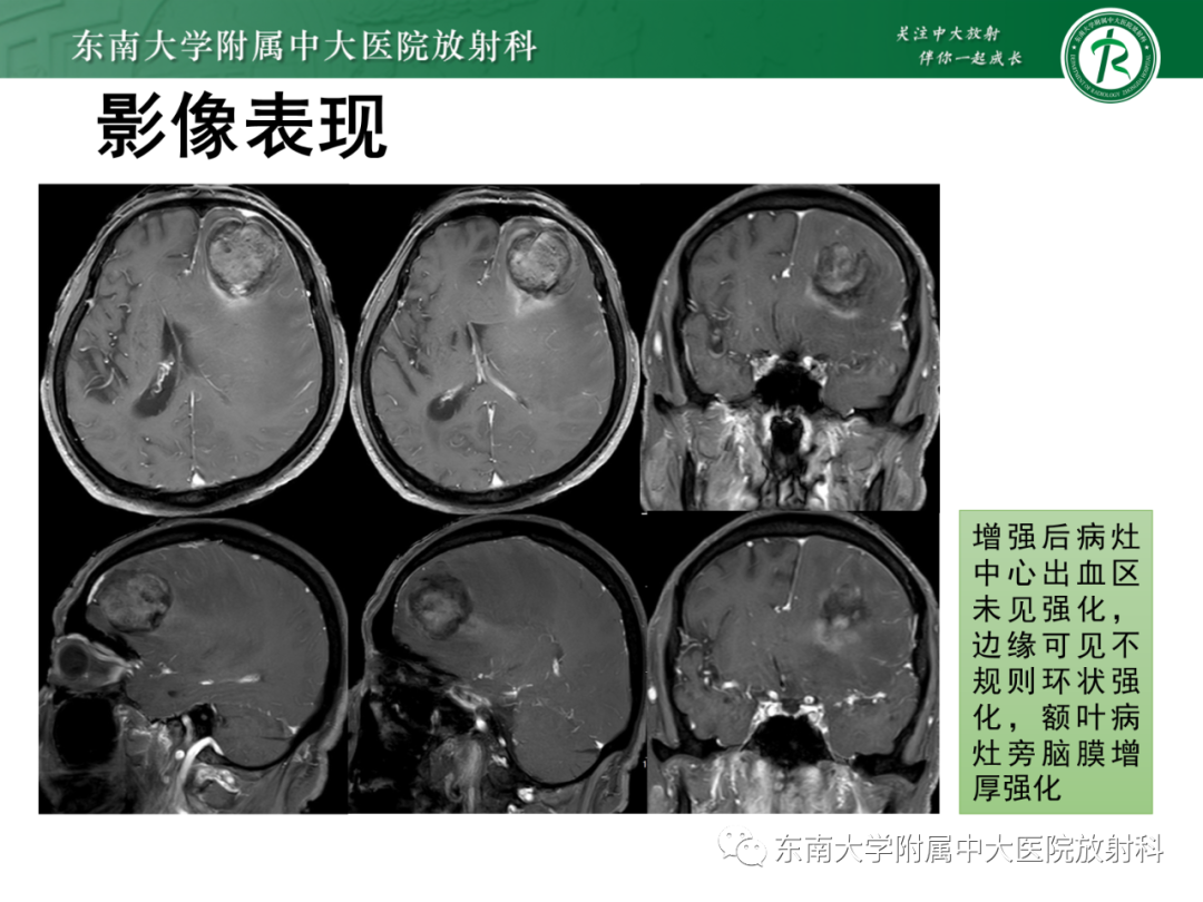 影像PPT - 【PPT】脑内血管肉瘤-4