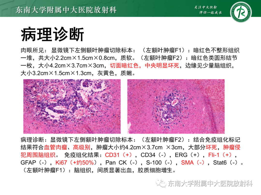 影像PPT - 【PPT】脑内血管肉瘤-6