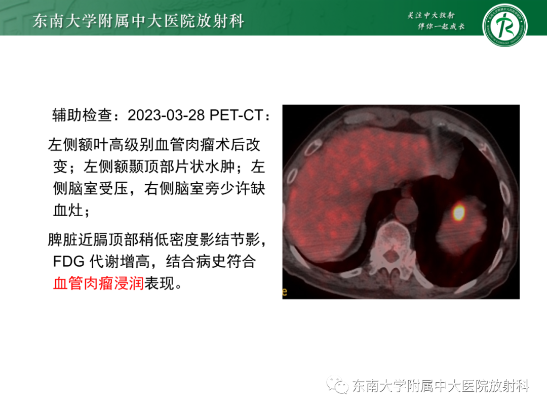 影像PPT - 【PPT】脑内血管肉瘤-7