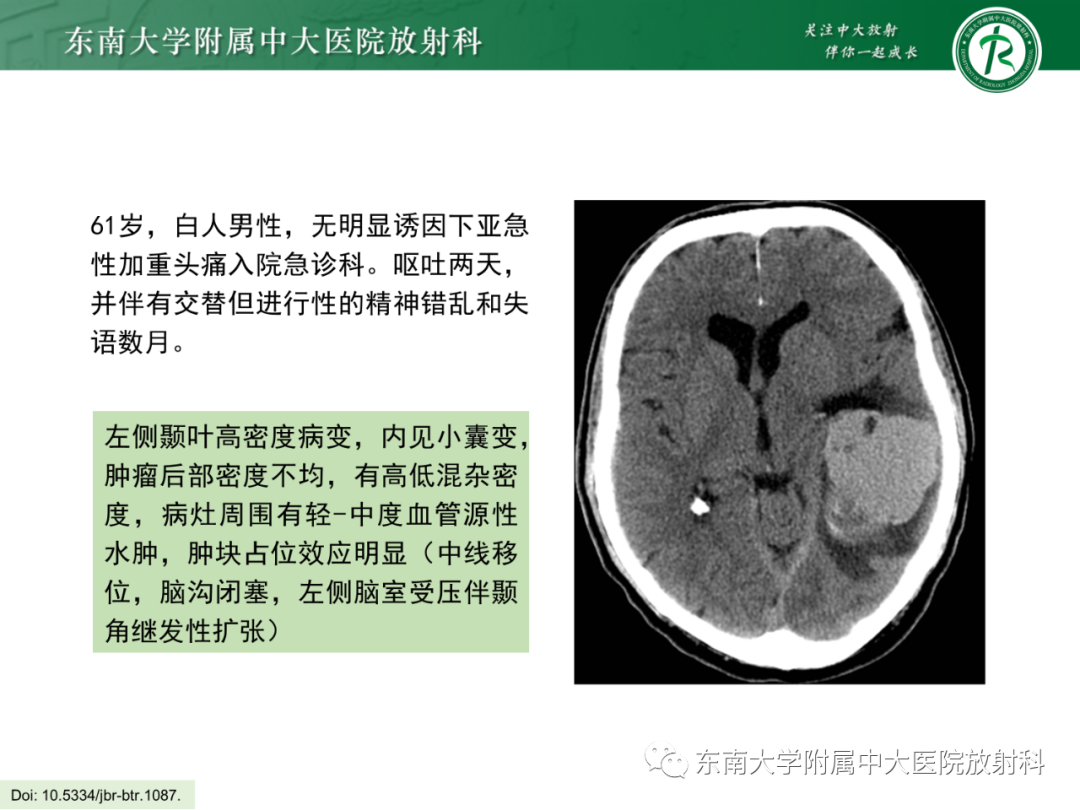 影像PPT - 【PPT】脑内血管肉瘤-16
