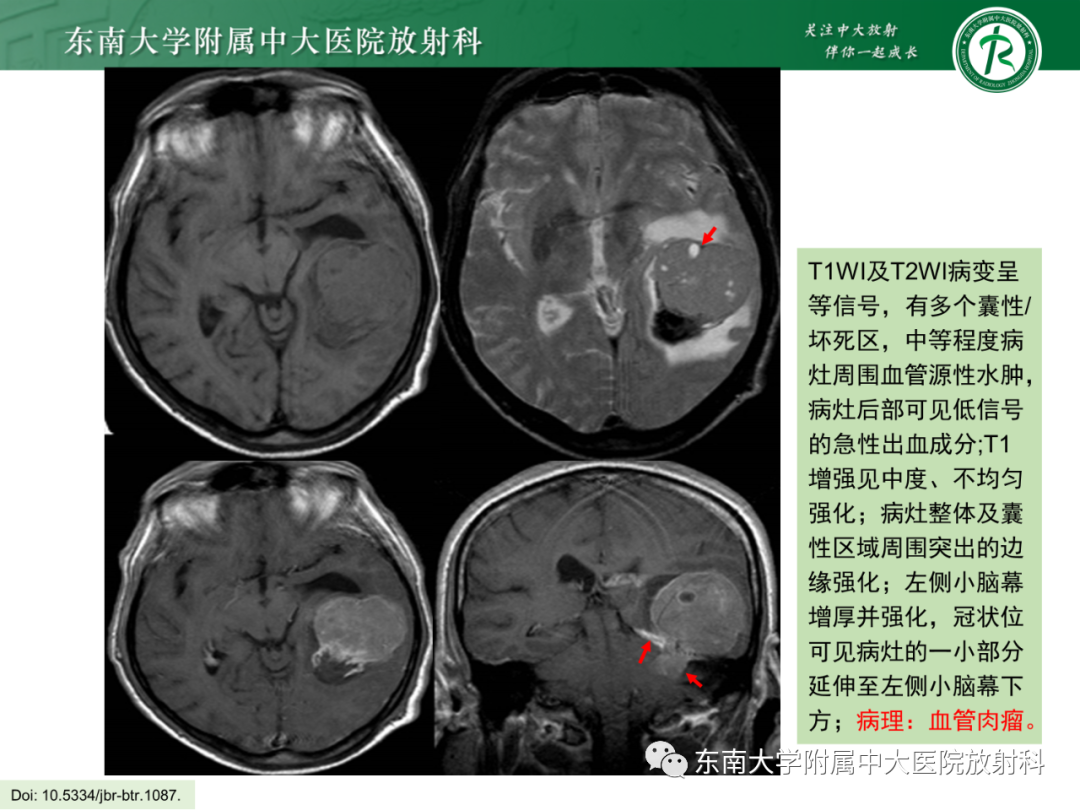 影像PPT - 【PPT】脑内血管肉瘤-17