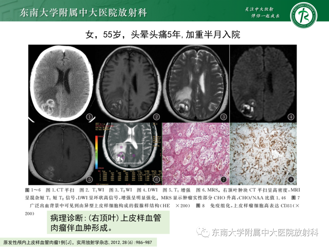 影像PPT - 【PPT】脑内血管肉瘤-19