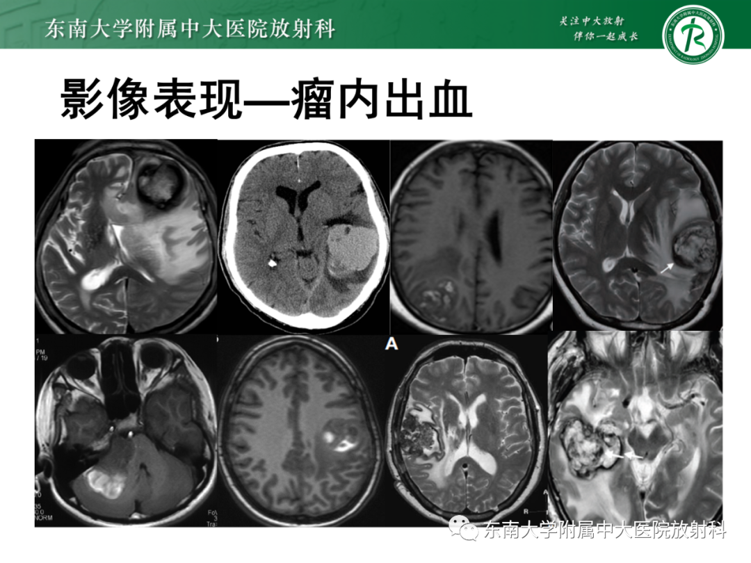 影像PPT - 【PPT】脑内血管肉瘤-23