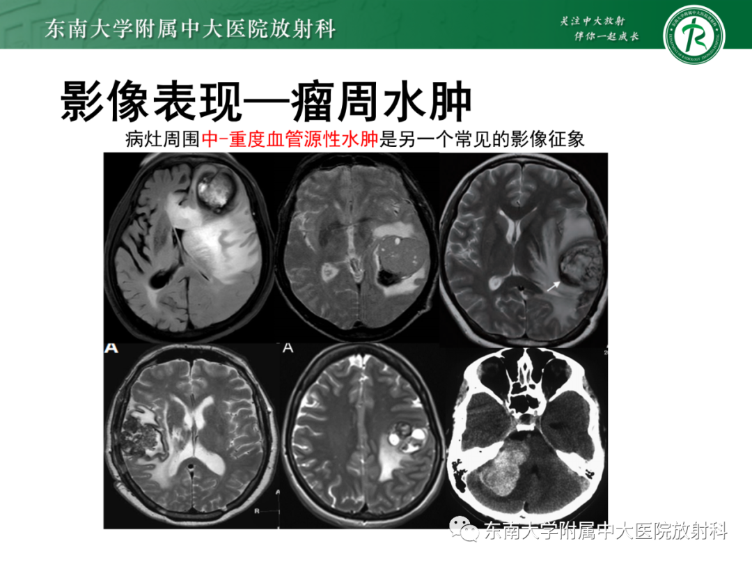 影像PPT - 【PPT】脑内血管肉瘤-24