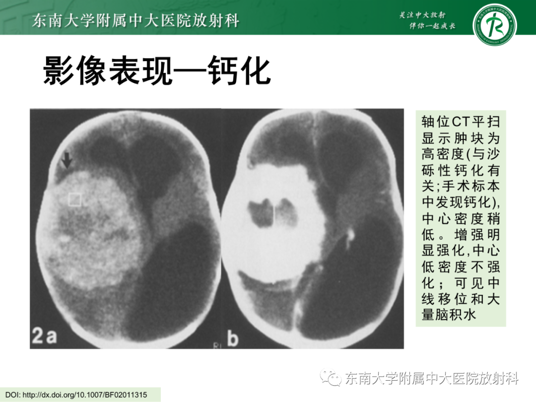 影像PPT - 【PPT】脑内血管肉瘤-25