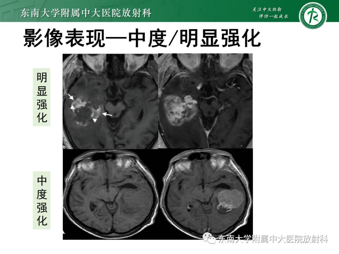 影像PPT - 【PPT】脑内血管肉瘤-26