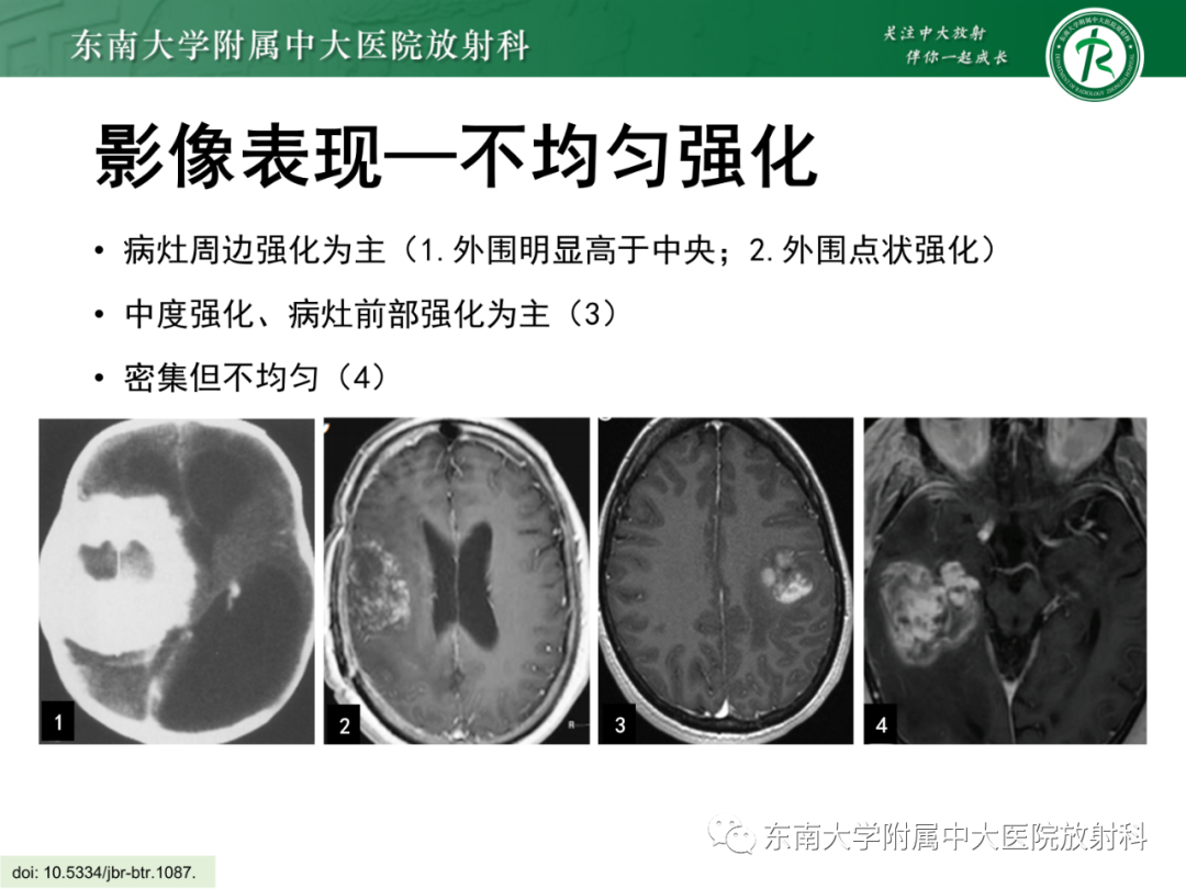 影像PPT - 【PPT】脑内血管肉瘤-27
