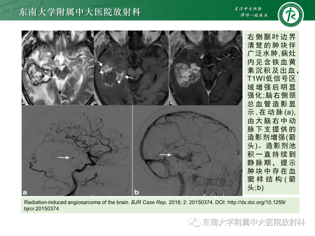 影像PPT - 【PPT】脑内血管肉瘤-29