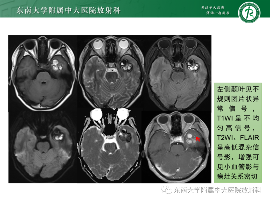 影像PPT - 【PPT】脑内血管肉瘤-34