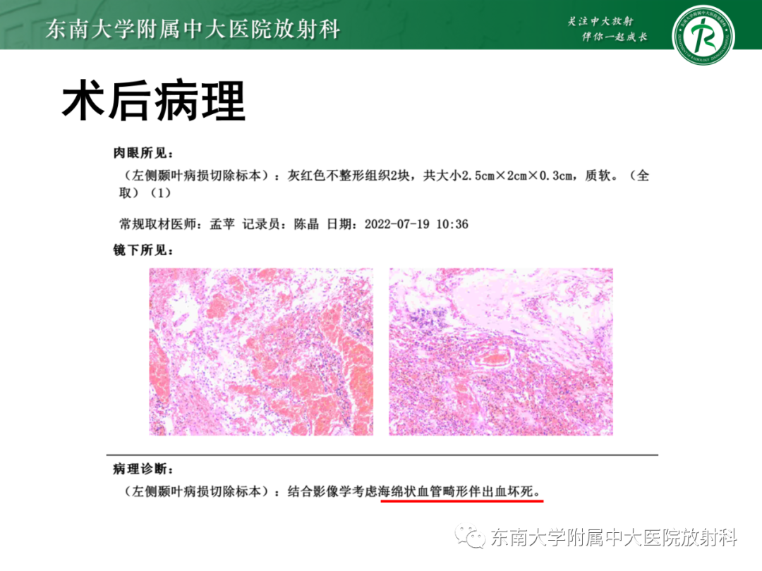 影像PPT - 【PPT】脑内血管肉瘤-36