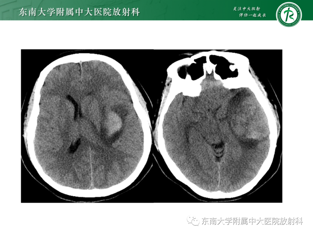 影像PPT - 【PPT】脑内血管肉瘤-39