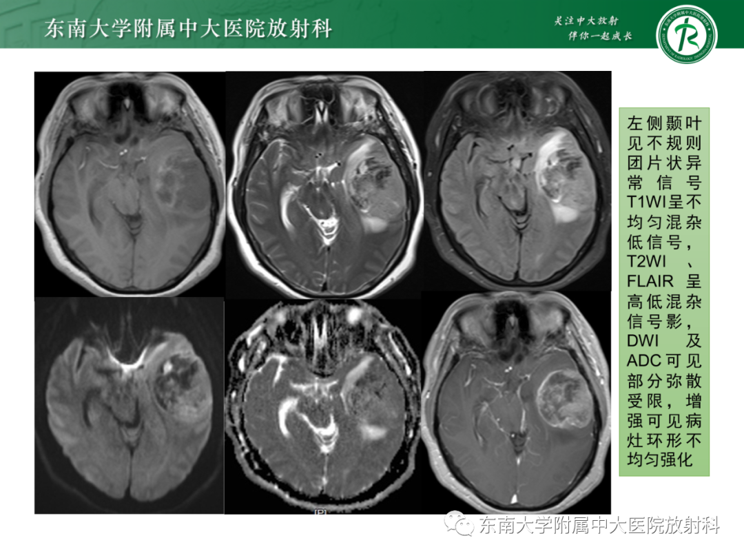 影像PPT - 【PPT】脑内血管肉瘤-40