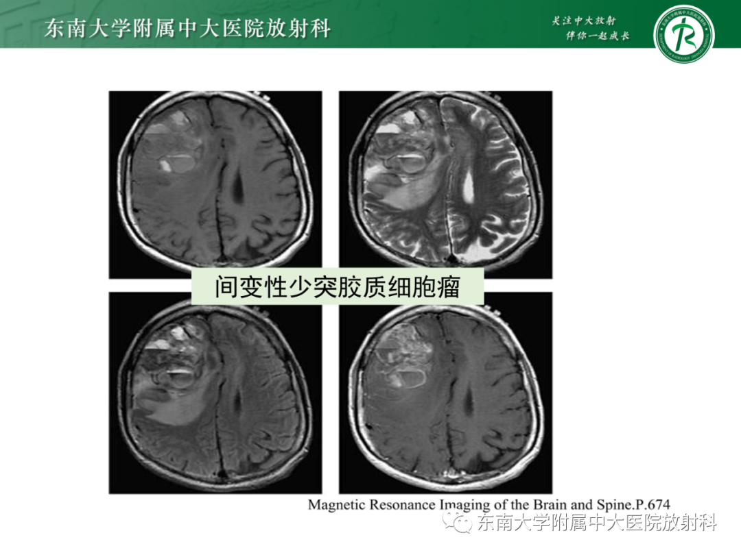 影像PPT - 【PPT】脑内血管肉瘤-43