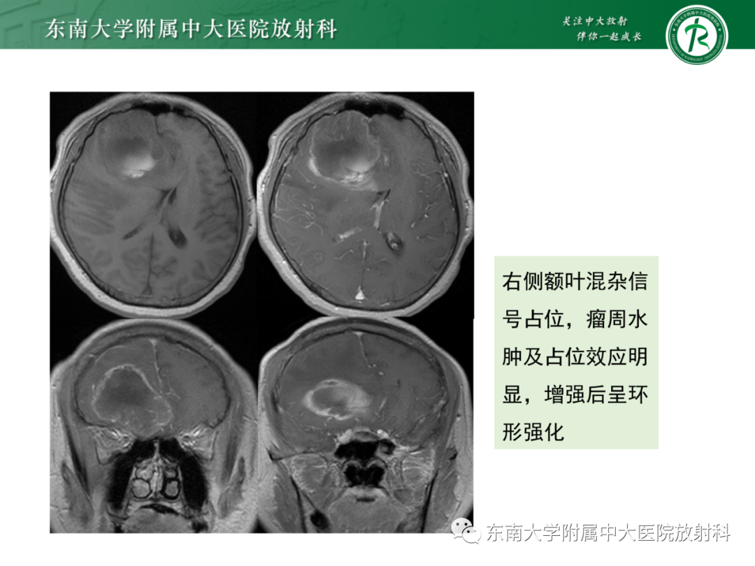 影像PPT - 【PPT】脑内血管肉瘤-46