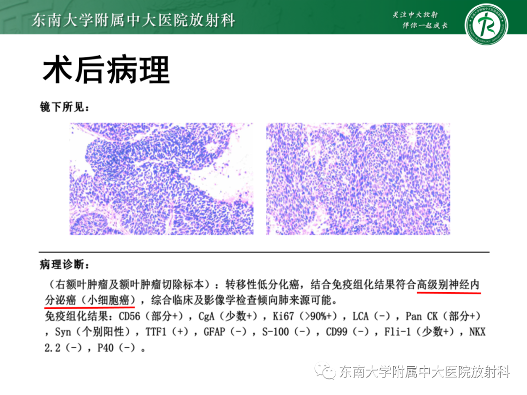 影像PPT - 【PPT】脑内血管肉瘤-48