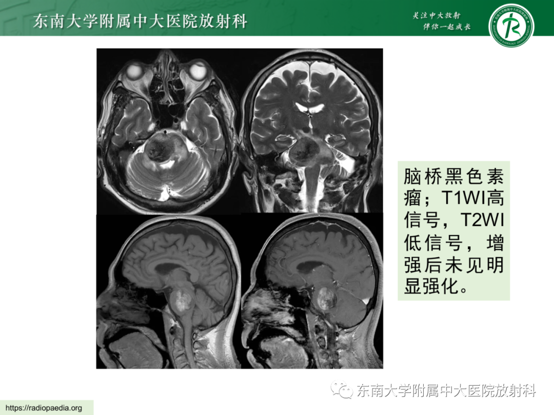 影像PPT - 【PPT】脑内血管肉瘤-50