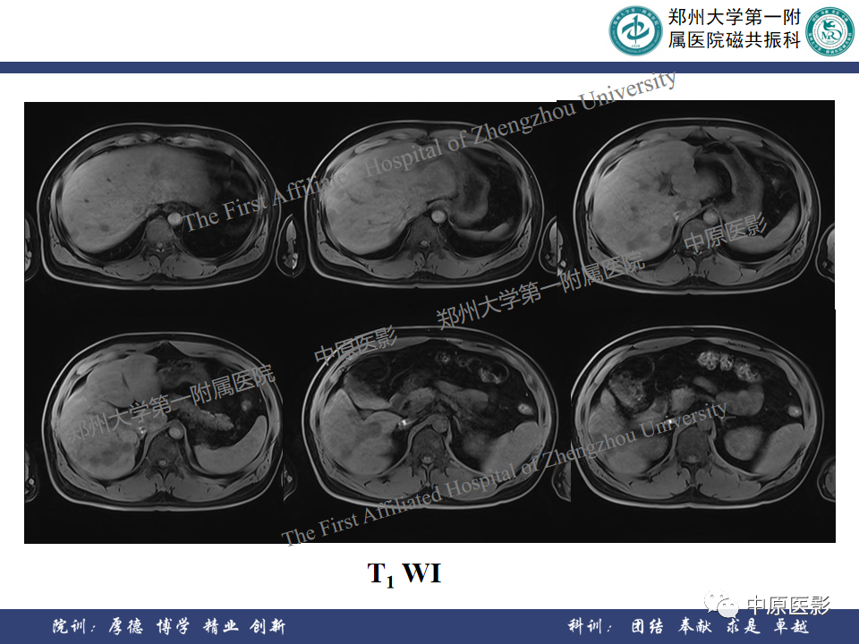 影像PPT - 【病例】肝脏上皮样血管内皮瘤1例MR影像-4