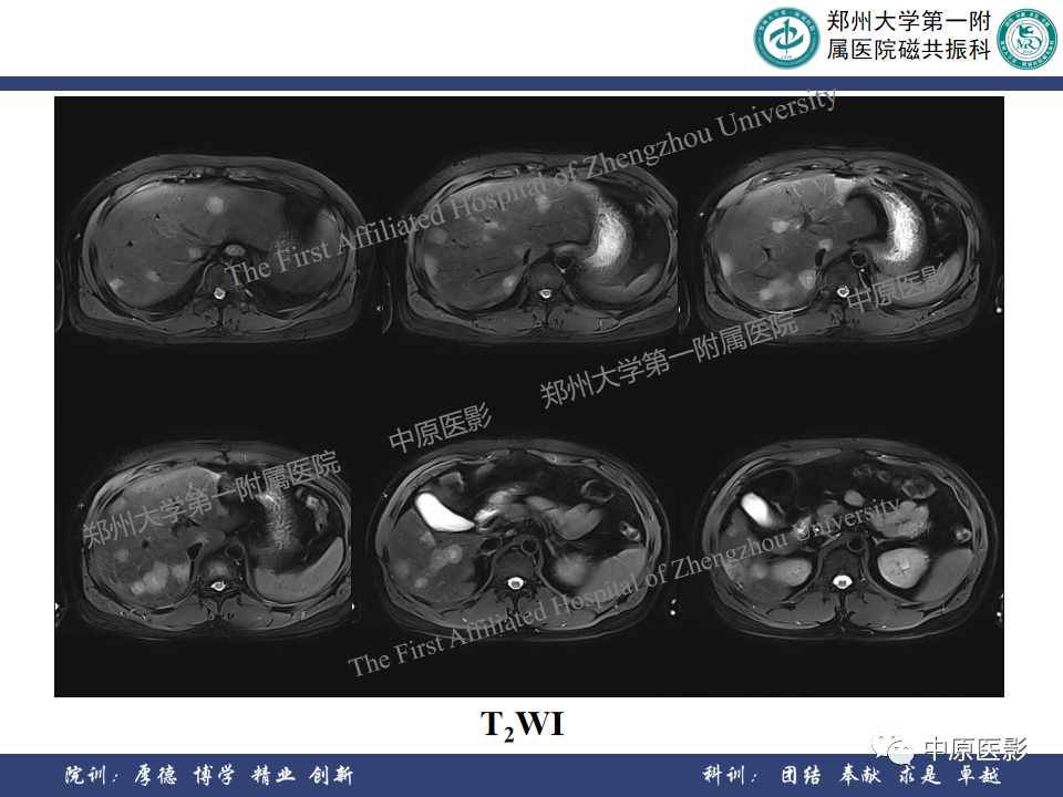 影像PPT - 【病例】肝脏上皮样血管内皮瘤1例MR影像-5