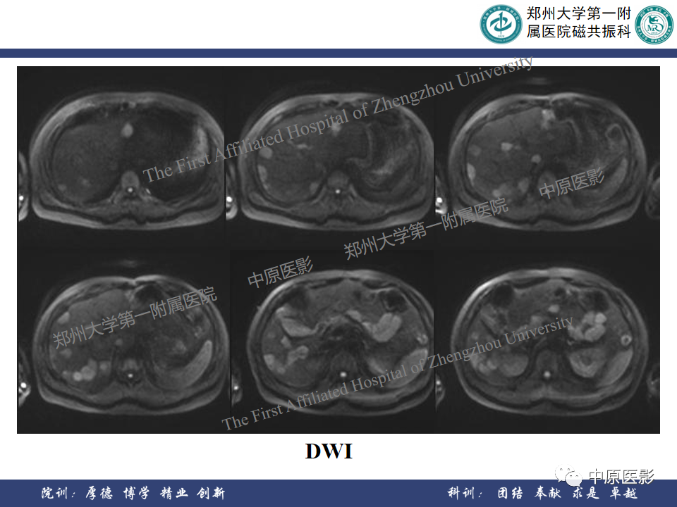 影像PPT - 【病例】肝脏上皮样血管内皮瘤1例MR影像-6