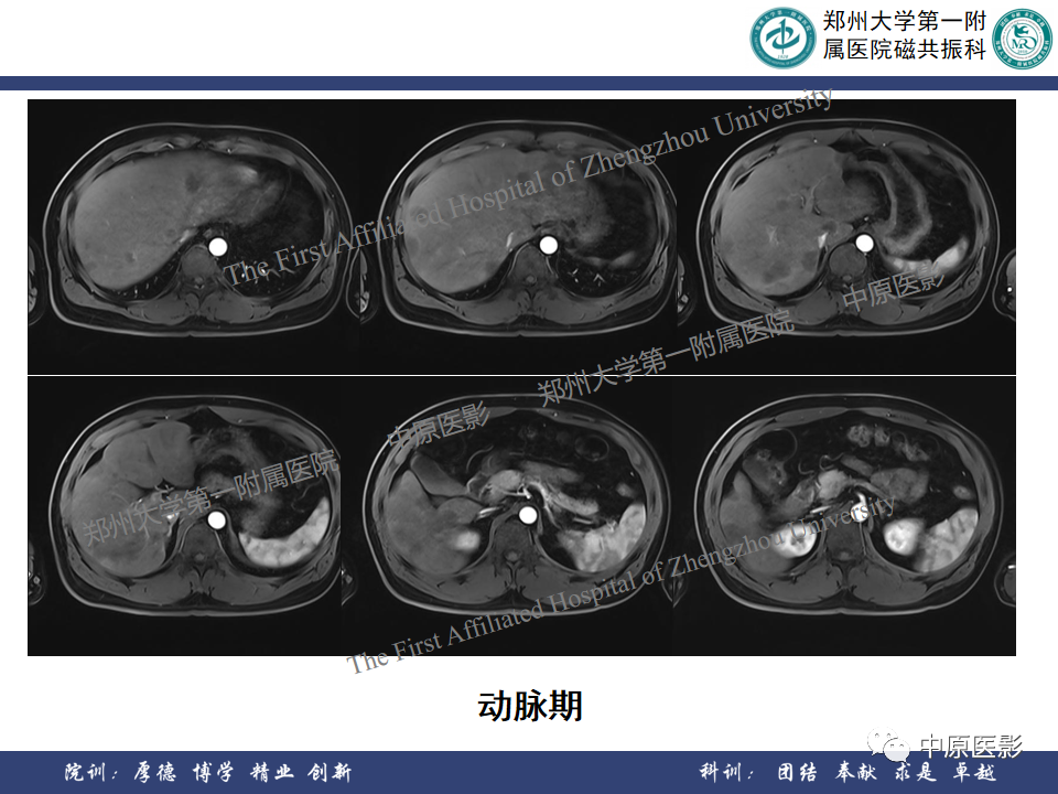 影像PPT - 【病例】肝脏上皮样血管内皮瘤1例MR影像-8