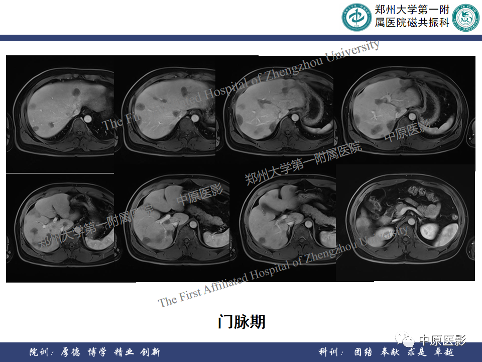 影像PPT - 【病例】肝脏上皮样血管内皮瘤1例MR影像-9
