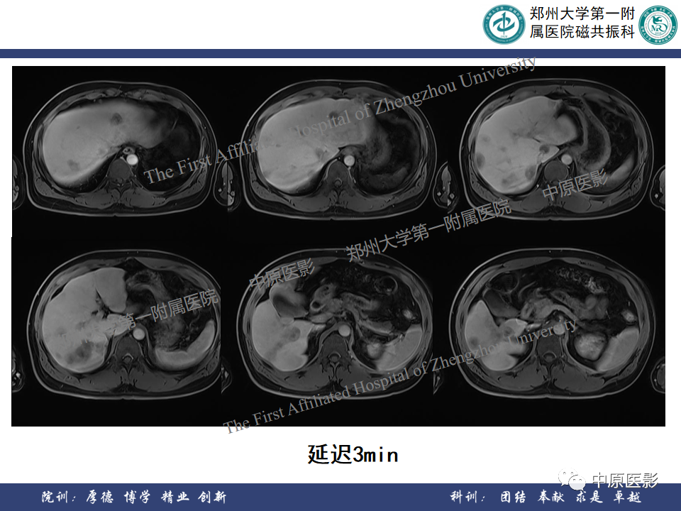 影像PPT - 【病例】肝脏上皮样血管内皮瘤1例MR影像-10