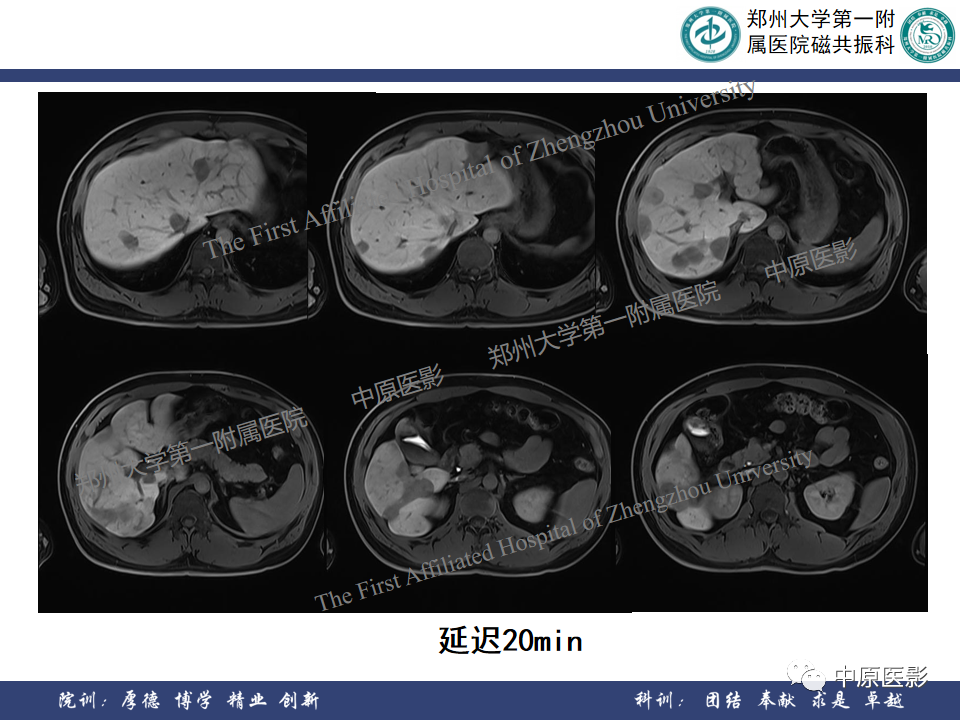 影像PPT - 【病例】肝脏上皮样血管内皮瘤1例MR影像-11