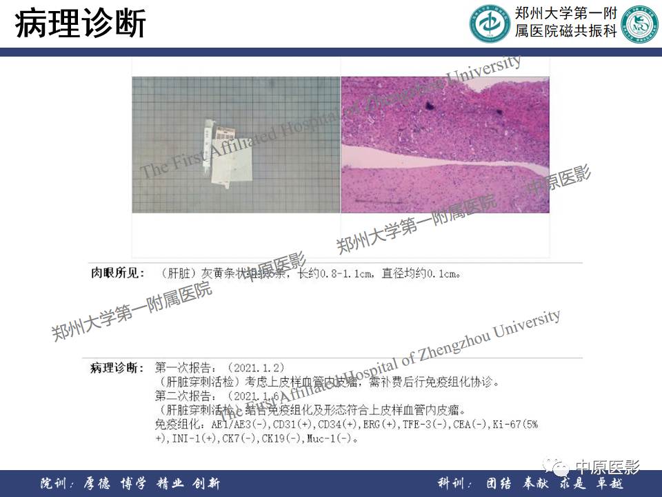 影像PPT - 【病例】肝脏上皮样血管内皮瘤1例MR影像-13