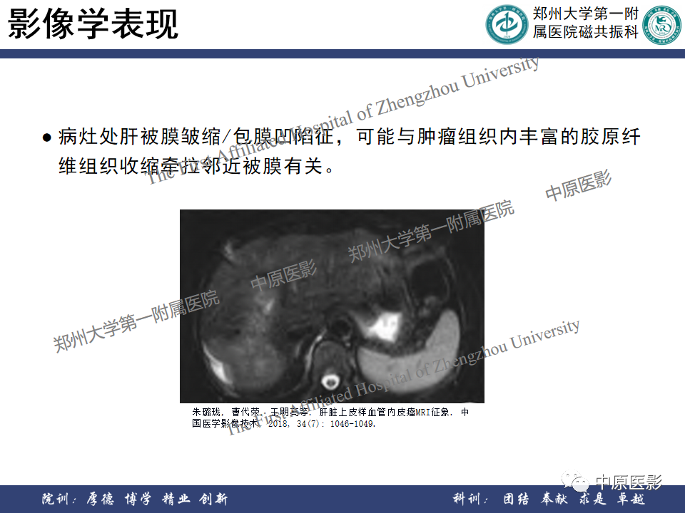 影像PPT - 【病例】肝脏上皮样血管内皮瘤1例MR影像-18