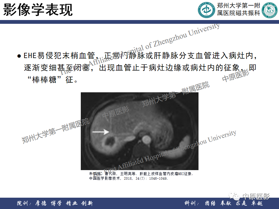 影像PPT - 【病例】肝脏上皮样血管内皮瘤1例MR影像-19